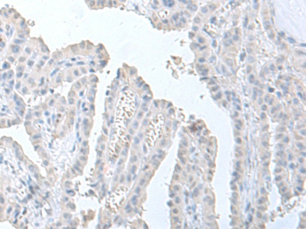 Immunohistochemistry of paraffin-embedded Human thyroid cancer tissue  using STAU2 Polyclonal Antibody at dilution of 1:60(?200)