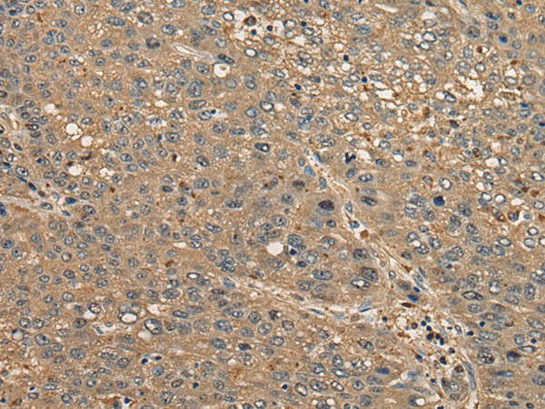 Immunohistochemistry of paraffin-embedded Human liver cancer tissue  using CCDC85C Polyclonal Antibody at dilution of 1:30(?200)