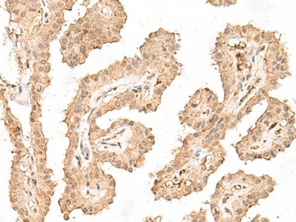 Immunohistochemistry of paraffin-embedded Human thyroid cancer tissue  using VPS50 Polyclonal Antibody at dilution of 1:30(?200)