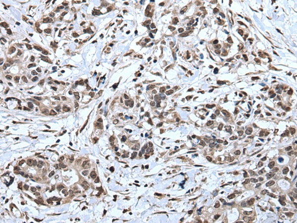 Immunohistochemistry of paraffin-embedded Human gastric cancer tissue  using TIA1 Polyclonal Antibody at dilution of 1:30(?200)