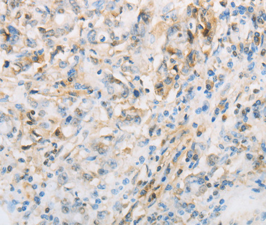 Immunohistochemistry of paraffin-embedded Human gasrtic cancer tissue using NPPC Polyclonal Antibody at dilution 1:70