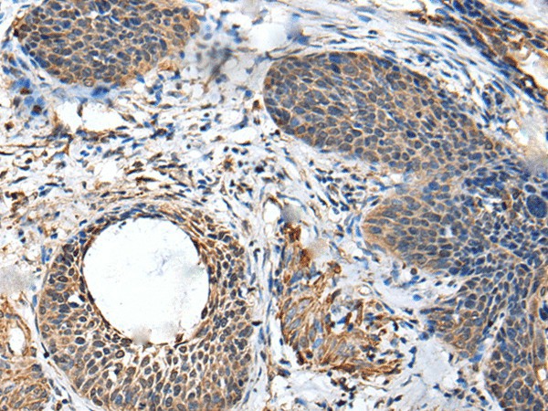 Immunohistochemistry of paraffin-embedded Human cervical cancer tissue  using BRI3BP Polyclonal Antibody at dilution of 1:35(?200)