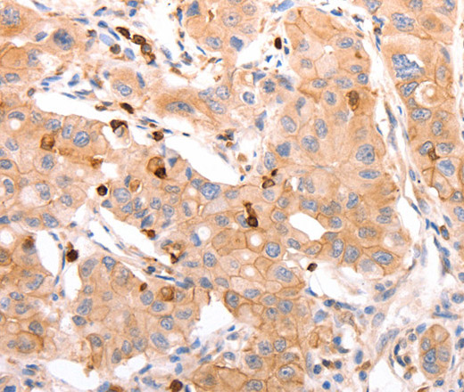 Immunohistochemistry of paraffin-embedded Human lung cancer tissue using CELSR2 Polyclonal Antibody at dilution 1:50