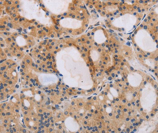 Immunohistochemistry of paraffin-embedded Human thyroid cancer tissue using ITPR1 Polyclonal Antibody at dilution 1:40