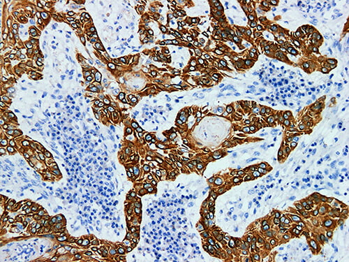 Immunohistochemistry of paraffinembedded Human cervical squamous cell carcinoma with Cytokeratin 5 Monoclonal Antibody(Antigen repaired by EDTA).