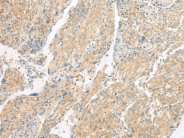 Immunohistochemistry of paraffin-embedded Human cervical cancer tissue  using HEBP1 Polyclonal Antibody at dilution of 1:60(?200)