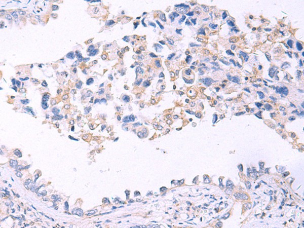 Immunohistochemistry of paraffin-embedded Human lung cancer tissue  using GRIA2 Polyclonal Antibody at dilution of 1:40(?200)