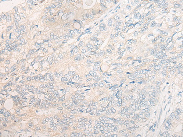 Immunohistochemistry of paraffin-embedded Human gastric cancer tissue  using CYB5R3 Polyclonal Antibody at dilution of 1:50(?200)