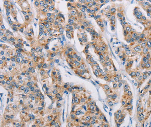 Immunohistochemistry of paraffin-embedded Human prostate cancer tissue using ATP2C1 Polyclonal Antibody at dilution 1:50