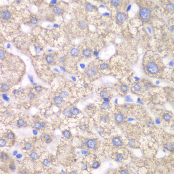 Immunohistochemistry of paraffin-embedded Human liver damage using ACAT1 Polyclonal Antibody at dilution of 1:100 (40x lens).