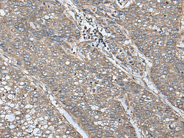 Immunohistochemistry of paraffin-embedded Human liver cancer tissue  using UQCRQ Polyclonal Antibody at dilution of 1:50(?200)