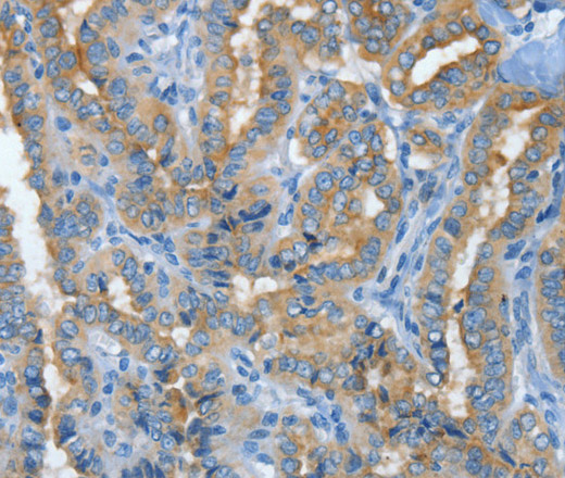 Immunohistochemistry of paraffin-embedded Human thyroid cancer tissue using MUC15 Polyclonal Antibody at dilution 1:50