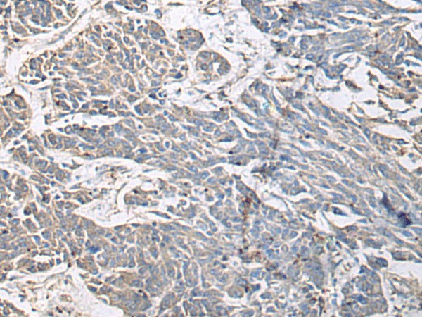 Immunohistochemistry of paraffin-embedded Human colorectal cancer tissue  using PRKCSH Polyclonal Antibody at dilution of 1:65(?200)