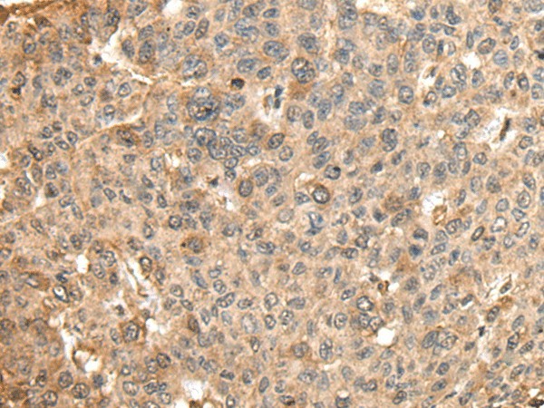 Immunohistochemistry of paraffin-embedded Human liver cancer tissue  using HMMR Polyclonal Antibody at dilution of 1:45(?200)