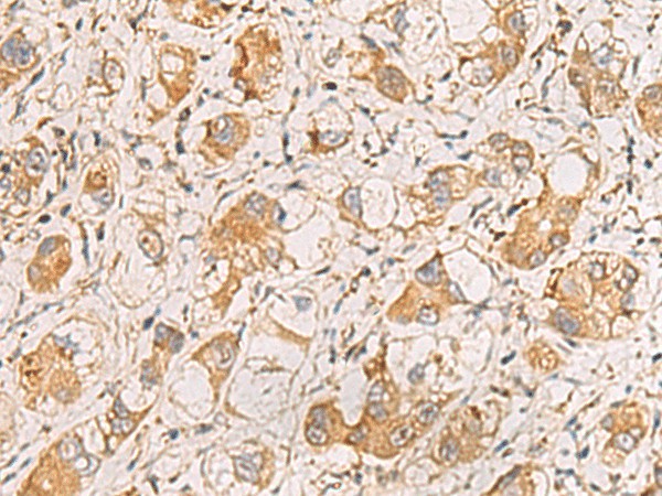 Immunohistochemistry of paraffin-embedded Human liver cancer tissue  using RAB38 Polyclonal Antibody at dilution of 1:60(?200)