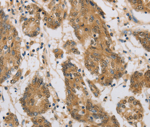 Immunohistochemistry of paraffin-embedded Human colon cancer tissue using CST6 Polyclonal Antibody at dilution 1:70