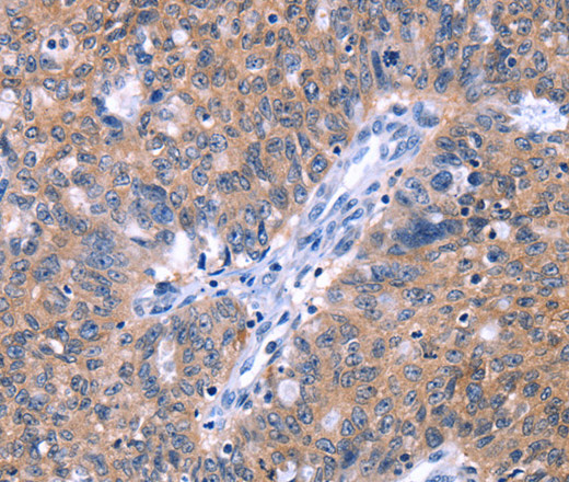 Immunohistochemistry of paraffin-embedded Human ovarian cancer tissue using ZNF395 Polyclonal Antibody at dilution 1:40