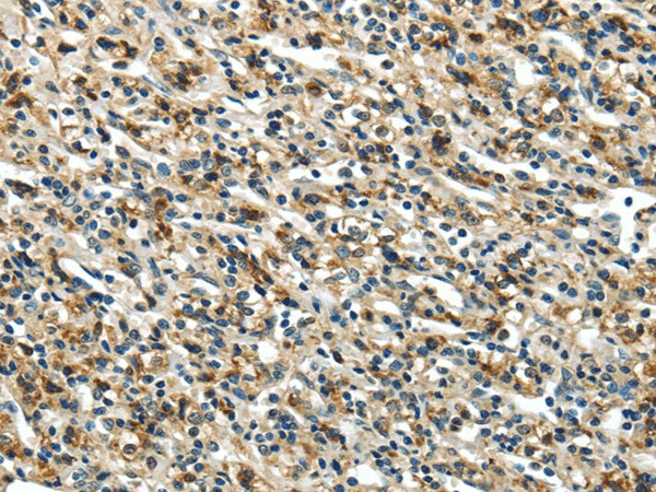 Immunohistochemistry of paraffin-embedded Human prostate cancer using GLP2R Polyclonal Antibody at dilution of  1/30