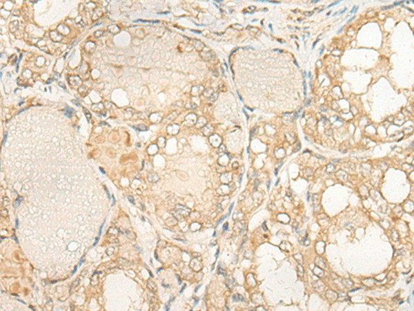 Immunohistochemistry of paraffin-embedded Human thyroid cancer tissue  using DUSP27 Polyclonal Antibody at dilution of 1:50(?200)