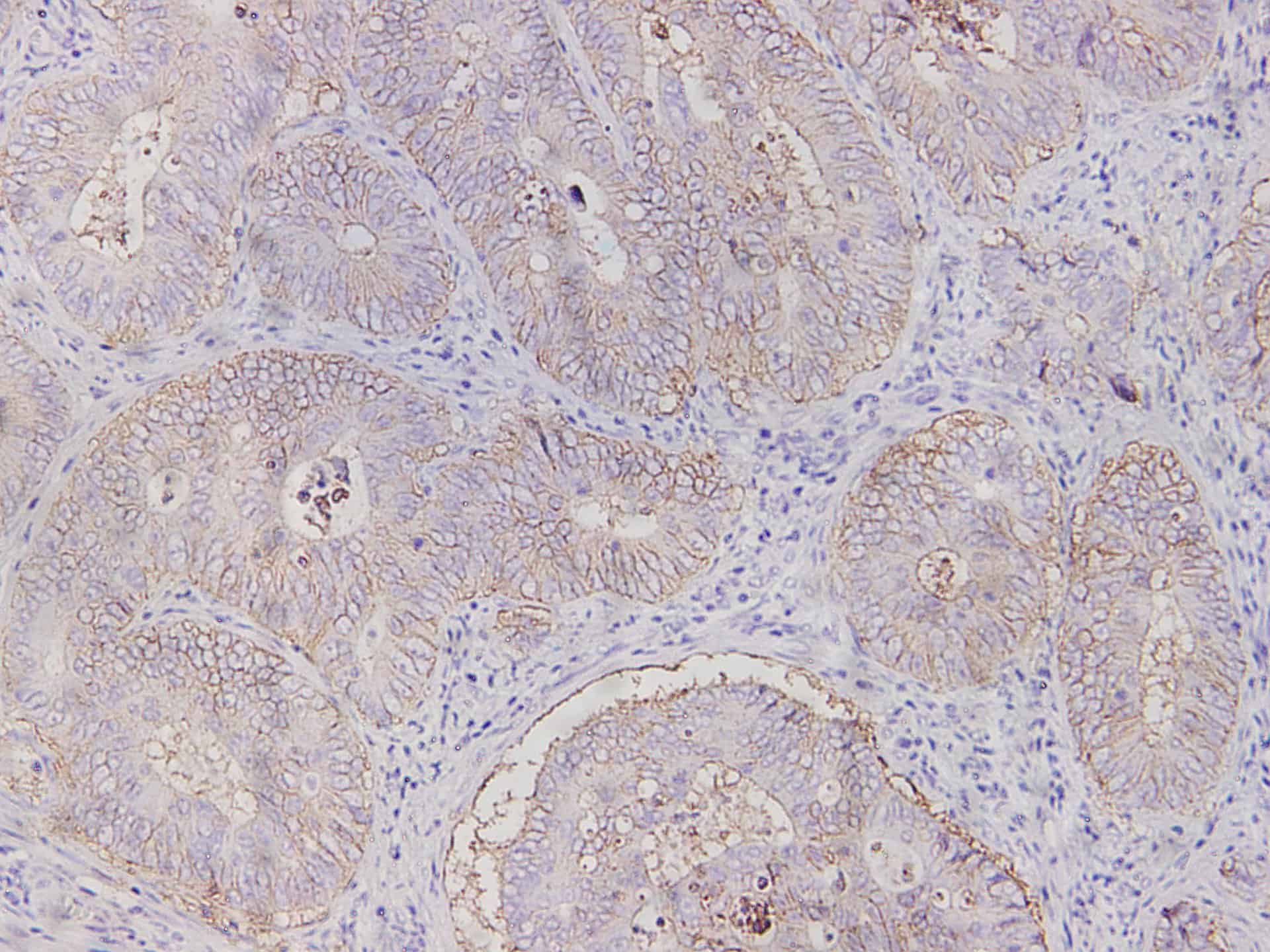 Immunohistochemistry of paraffin-embedded Human colon cancer tissue using EpCAM Polyclonal Antibody at dilution of 1:700(?200)