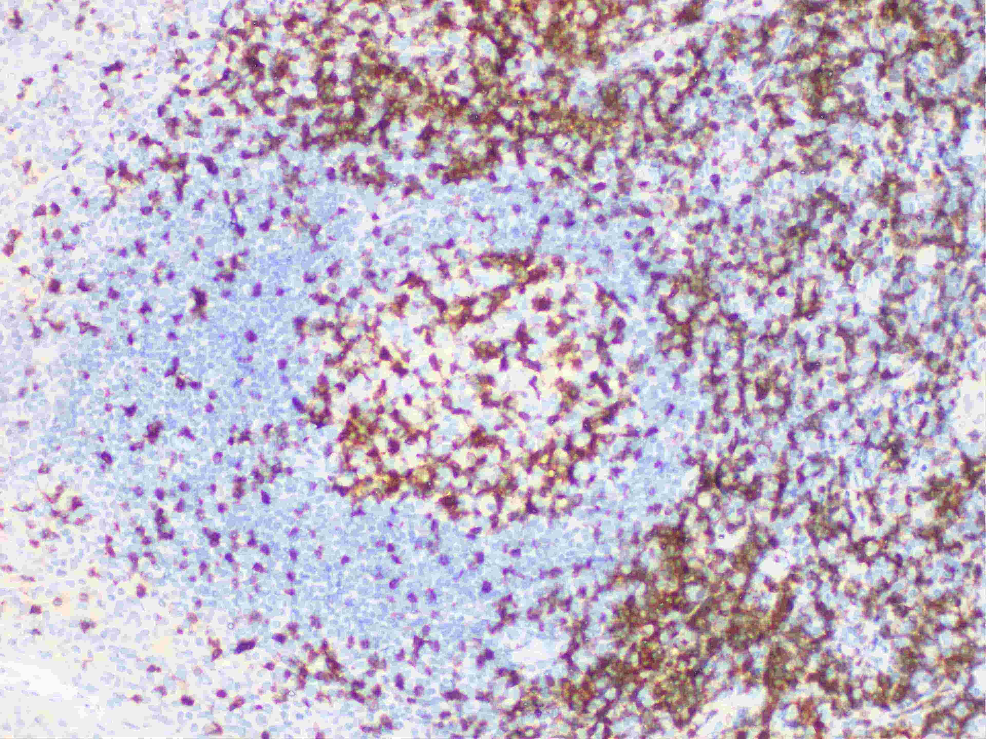 Immunohistochemistry of paraffinembedded Human tonsil tissue with ZAP-70 Monoclonal Antibody(Antigen repaired by EDTA).