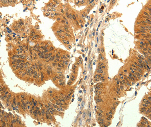 Immunohistochemistry of paraffin-embedded Human colon cancer tissue using TRPM7 Polyclonal Antibody at dilution 1:30