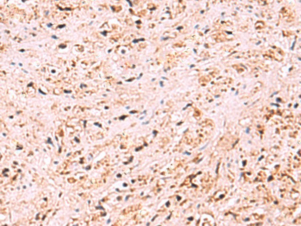 Immunohistochemistry of paraffin-embedded Human prost at e cancer tissue  using ZSWIM1 Polyclonal Antibody at dilution of 1:95(?200)