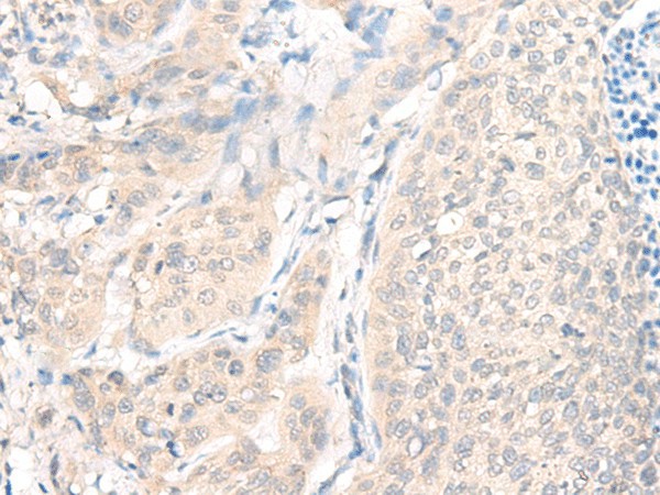 Immunohistochemistry of paraffin-embedded Human cervical cancer tissue  using AOAH Polyclonal Antibody at dilution of 1:25(?200)