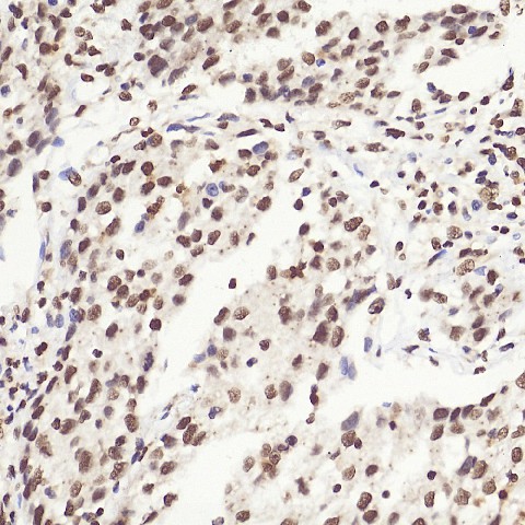 Immunohistochemistry analysis of paraffin-embedded Human liver cancer  using HMGB1 Polyclonal Antibody at dilution of 1:500.