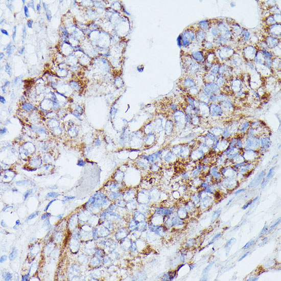 Immunohistochemistry of paraffin-embedded Human colon carcinoma using MANBA Polyclonal Antibody at dilution of 1:100 (40x lens).