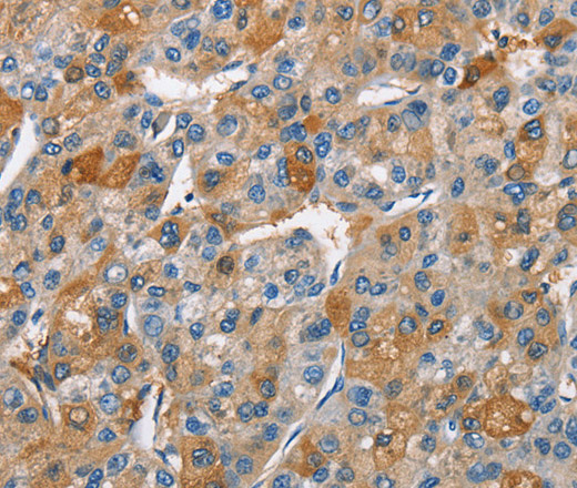 Immunohistochemistry of paraffin-embedded Human liver cancer using BCL10 Polyclonal Antibody at dilution of 1:40