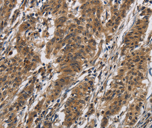 Immunohistochemistry of paraffin-embedded Human gasrtic cancer tissue using IL12RB2 Polyclonal Antibody at dilution 1:40