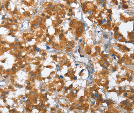 Immunohistochemistry of paraffin-embedded Human thyroid cancer using TP53BP2 Polyclonal Antibody at dilution of 1:35