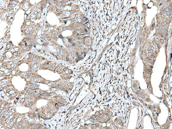 Immunohistochemistry of paraffin-embedded Human colorectal cancer tissue  using RAD54B Polyclonal Antibody at dilution of 1:45(?200)