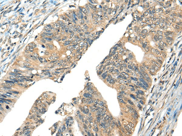 Immunohistochemistry of paraffin-embedded Human colorectal cancer tissue  using AIFM2 Polyclonal Antibody at dilution of 1:40(?200)