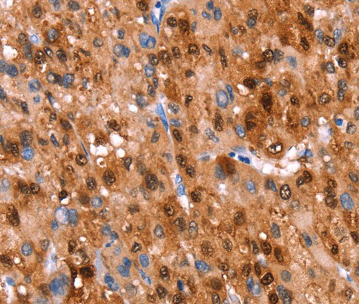 Immunohistochemistry of paraffin-embedded Human liver cancer using GH1 Polyclonal Antibody at dilution of 1:40