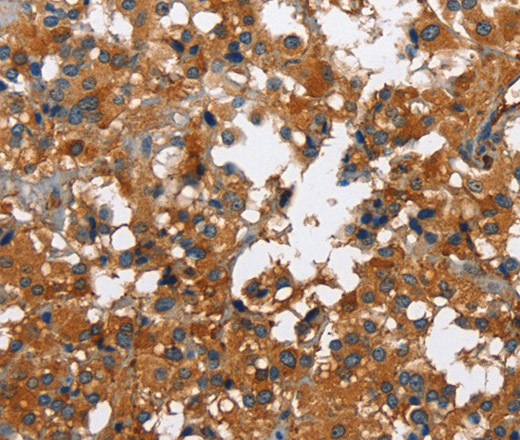 Immunohistochemistry of paraffin-embedded Human thyroid cancer tissue using CATSPER3 Polyclonal Antibody at dilution 1:60