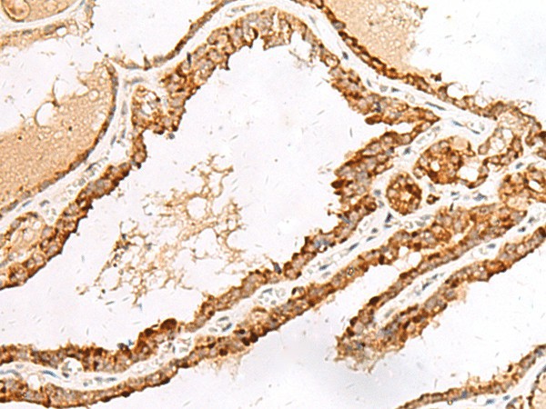 Immunohistochemistry of paraffin-embedded Human thyroid cancer tissue  using LGALSL Polyclonal Antibody at dilution of 1:70(?200)