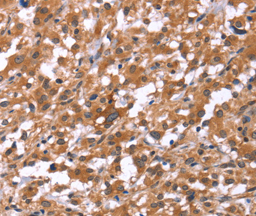 Immunohistochemistry of paraffin-embedded Human thyroid cancer using HSD17B1 Polyclonal Antibody at dilution of 1:40