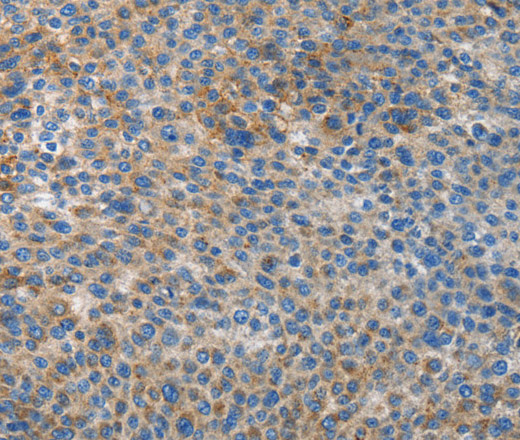 Immunohistochemistry of paraffin-embedded Human liver cancer tissue using ATG4B Polyclonal Antibody at dilution 1:50