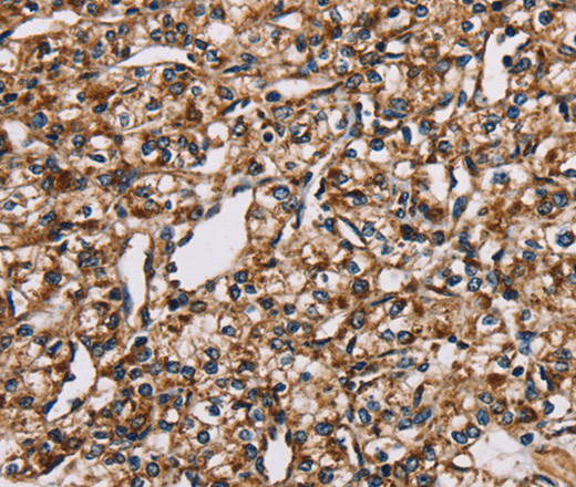 Immunohistochemistry of paraffin-embedded Human prostate cancer using NDUFS1 Polyclonal Antibody at dilution of 1:35