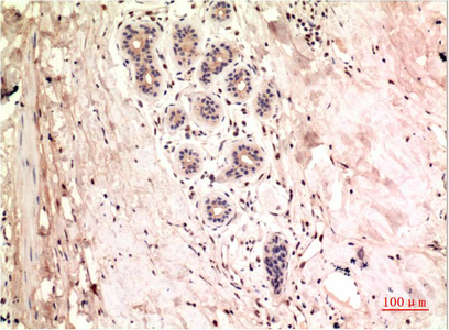 Immunohistochemistry of paraffin-embedded Human breast carcinoma tissue using gamma Tubulin Monoclonal Antibody at dilution of 1:200.