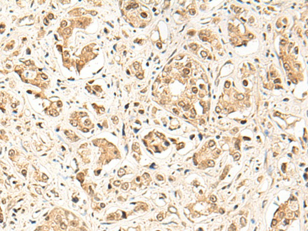 Immunohistochemistry of paraffin-embedded Human prost ate cancer tissue  using GPR139 Polyclonal Antibody at dilution of 1:50(?200)