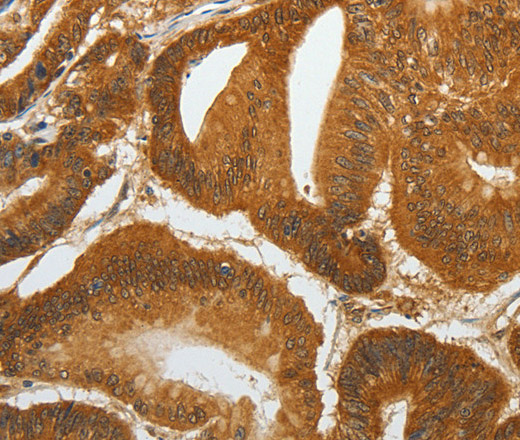 Immunohistochemistry of paraffin-embedded Human colon cancer tissue using RETNLB Polyclonal Antibody at dilution 1:40