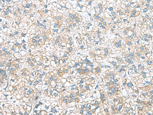 Immunohistochemistry of paraffin-embedded Human liver cancer tissue  using RAB13 Polyclonal Antibody at dilution of 1:50(?200)