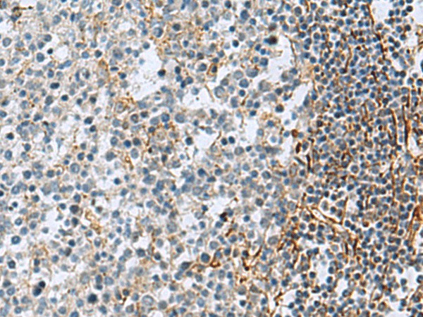 Immunohistochemistry of paraffin-embedded Human tonsil tissue  using GLS Polyclonal Antibody at dilution of 1:70(?200)