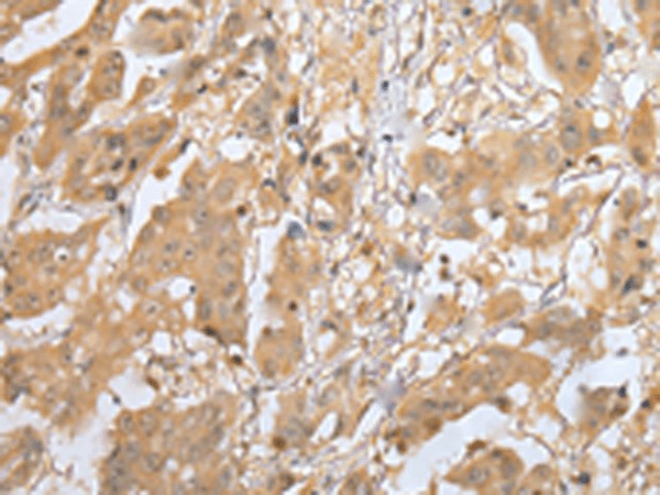 Immunohistochemistry of paraffin-embedded Human breast cancer tissue  using MOB4 Polyclonal Antibody at dilution of 1:25(?200)