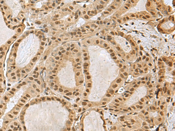 Immunohistochemistry of paraffin-embedded Human thyroid cancer tissue  using PRPF40A Polyclonal Antibody at dilution of 1:60(?200)