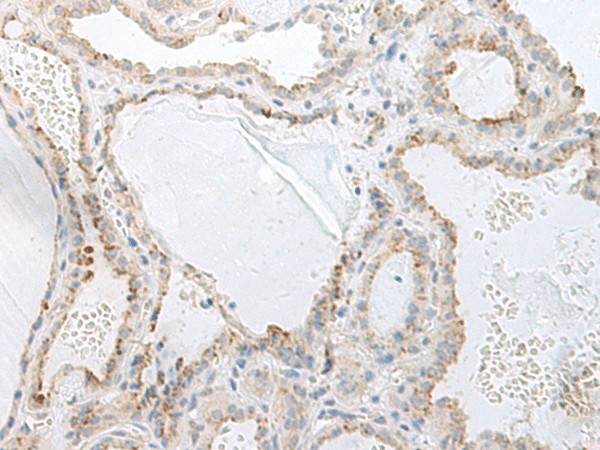 Immunohistochemistry of paraffin-embedded Human thyroid cancer tissue  using GPRASP2 Polyclonal Antibody at dilution of 1:75(?200)