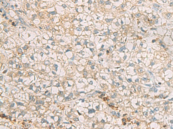 Immunohistochemistry of paraffin-embedded Human liver cancer tissue  using SLC30A6 Polyclonal Antibody at dilution of 1:70(?200)